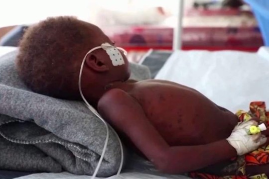 وفاة أكثر من 150 طفلا بالحصبة خلال أسبوعين في زيمبابوي